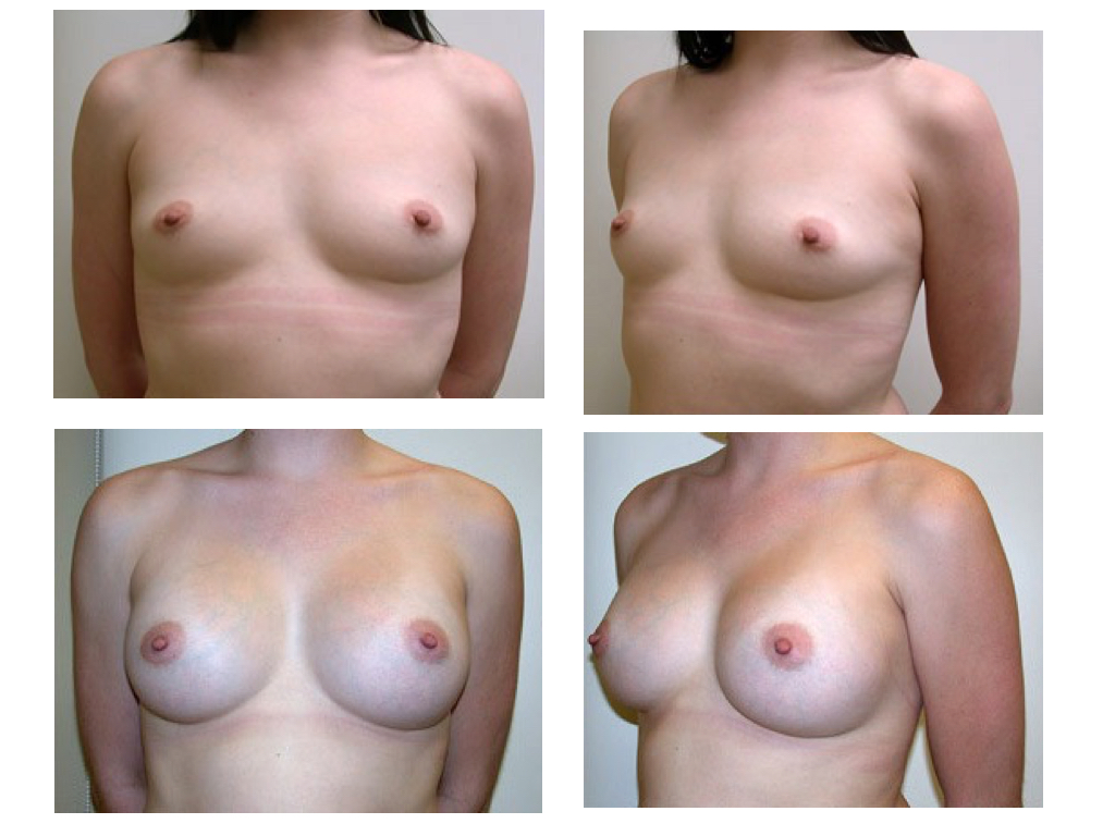 BREAST AUGMENTATION